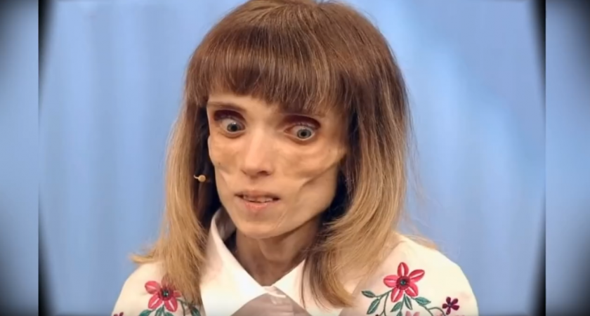 "У меня давно нет весов”: девушка, которая весила 17 килограммов, рассказала о борьбе с анорексией